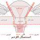 Scheme hysterectomy ar.svg