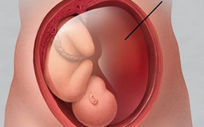 زيادة السائل الامنيوسي حول الجنين