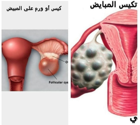 الفرق بين تكيسات المبايض و وجود كيس او ورم على المبيض