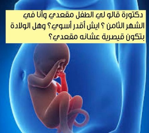 ولادة الجنين المقعدي ، طريقه لف الجنين المقعدي