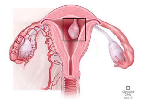 لحمية الرحم قد تسبب لخبطة الدورة وغزارتها