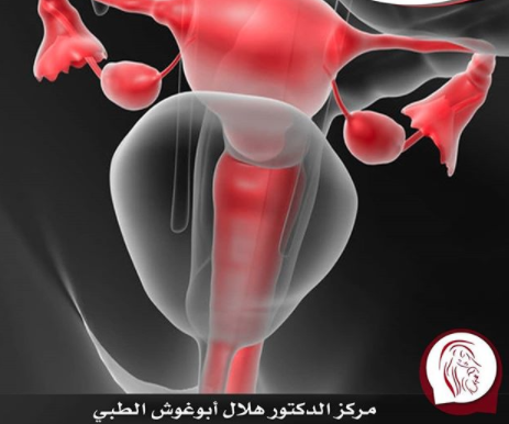 التصوير المائي للرحم و بطانة الرحم