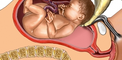 أضرار الولادة القيصرية للجنين