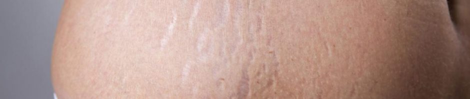 طرق علاج علامات تمدد الجلد بعد الولادة