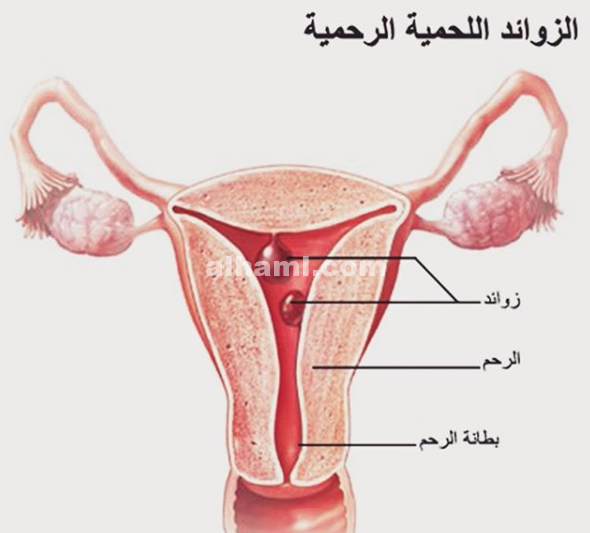 ماهي الزوائد اللحمية في الرحم الحامل الحمل والولادة