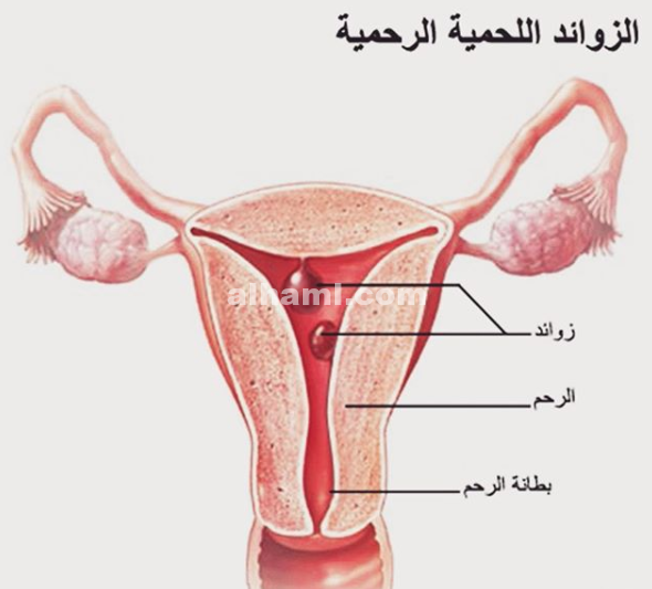 ماهي الزوائد اللحمية في الرحم