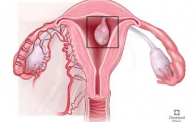 لحمية الرحم قد تسبب لخبطة الدورة وغزارتها